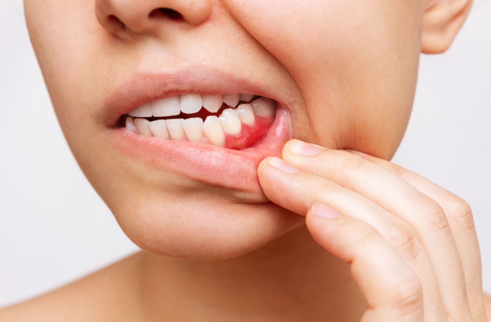 Person pulling their lip down with their hand to reveal red, irritated gumline.