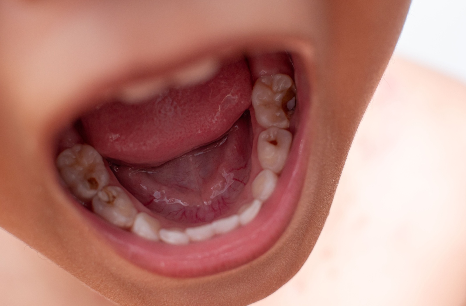 Close-up of a child’s open mouth showing early cavities on the back teeth.