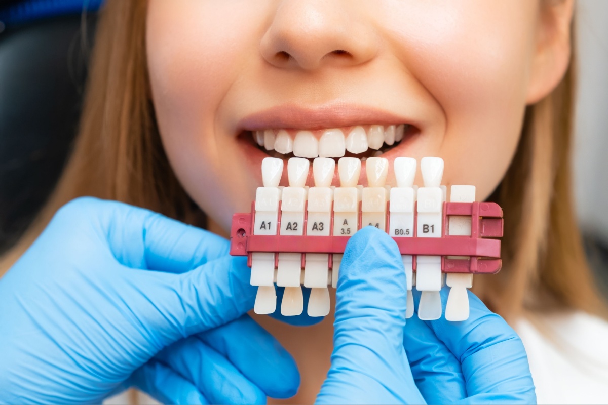 A dentist matching a tooth shade guide to the natural colour of the patient's teeth.
