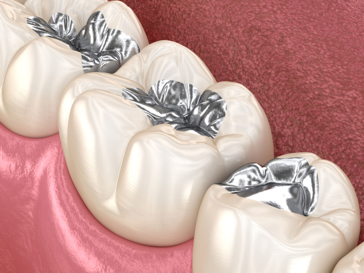 are mercury amalgam fillings safe